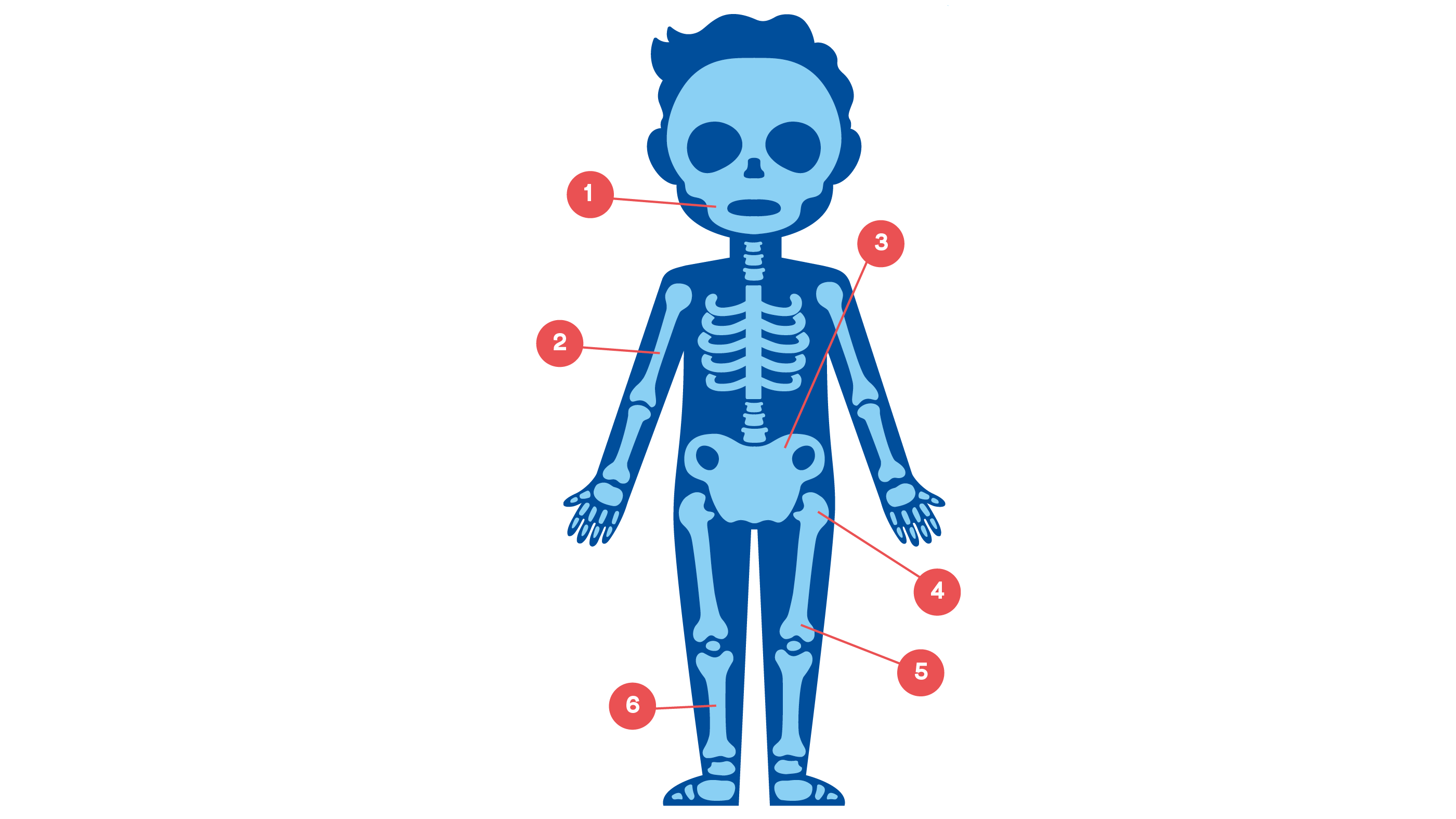 Illustration osteosarkom