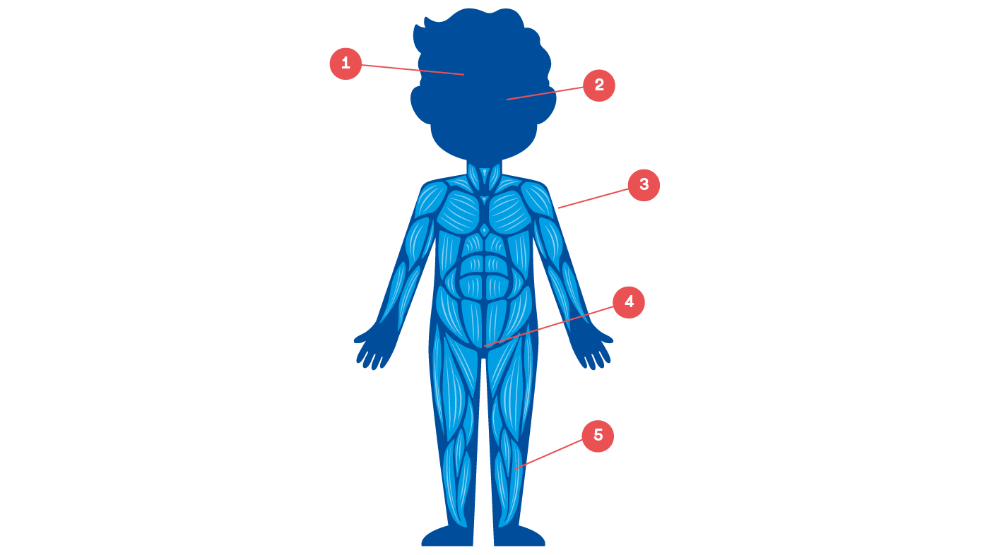 Illustration rhabdomyosarkom