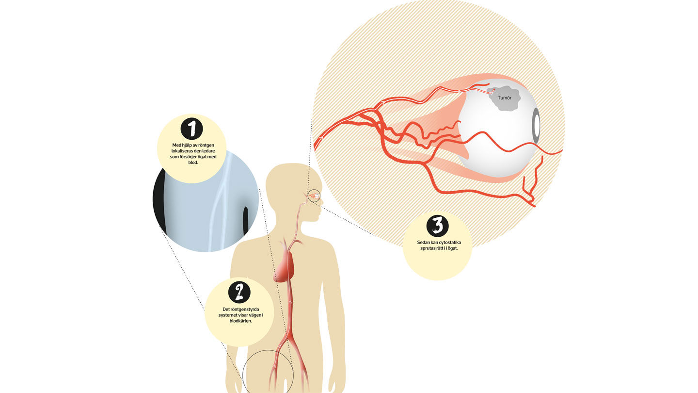 Illustration av ett öga och hur cytostatika färdas via blodkärl från ljumsken.